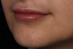 Injectable Fillers