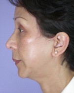 Cheek/Chin Shaping