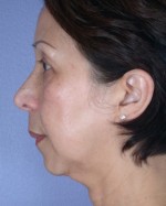 Cheek/Chin Shaping Before and after photo