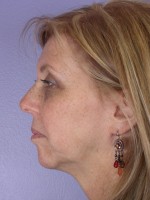 Cheek/Chin Shaping Before and after photo