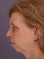 Cheek/Chin Shaping Before and after photo