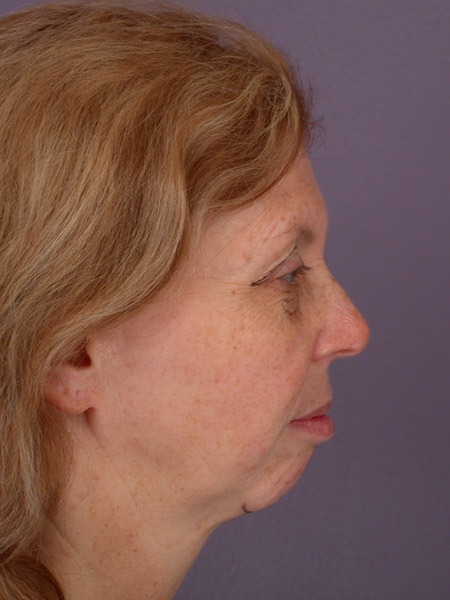 Cheek/Chin Shaping before and after photo