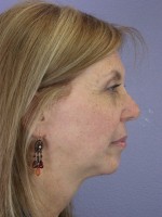 Cheek/Chin Shaping Before and after photo