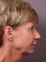 Cheek/Chin Shaping Before and after photo