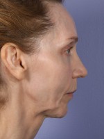 Cheek/Chin Shaping Before and after photo