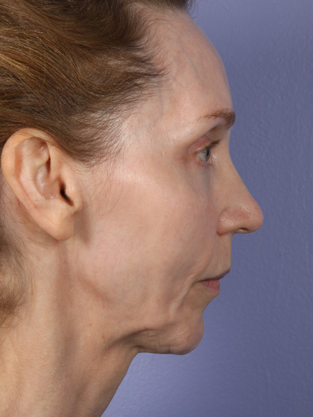 Cheek/Chin Shaping before and after photo