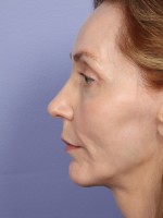 Cheek/Chin Shaping Before and after photo