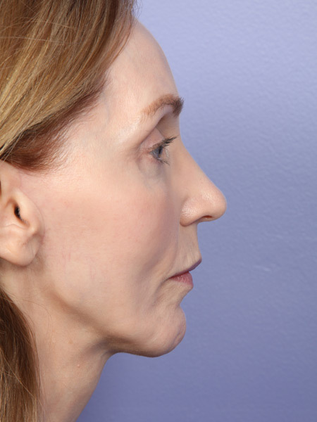 Cheek/Chin Shaping before and after photo