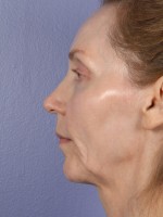 Cheek/Chin Shaping Before and after photo