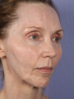 Cheek/Chin Shaping Before and after photo