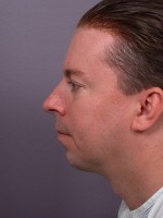 Cheek/Chin Shaping Before and after photo