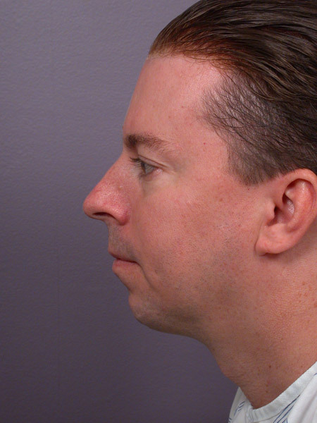 Cheek/Chin Shaping before and after photo