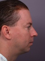 Cheek/Chin Shaping Before and after photo