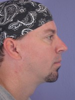 Cheek/Chin Shaping Before and after photo