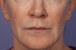Injectable Fillers
