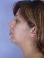 Cheek/Chin Shaping