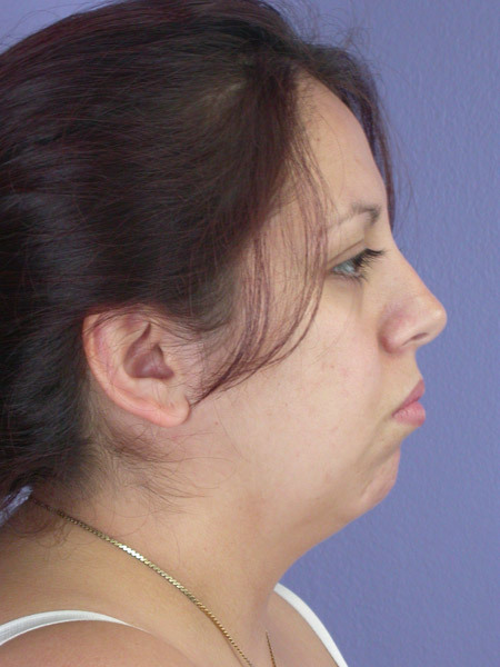 Cheek/Chin Shaping before and after photo