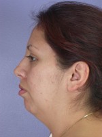 Cheek/Chin Shaping Before and after photo