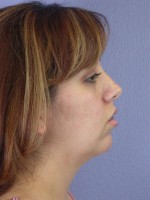 Cheek/Chin Shaping Before and after photo