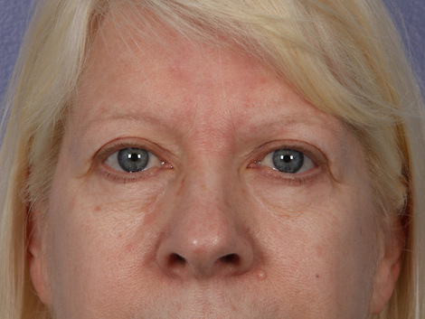 Eyelid Surgery before and after photo