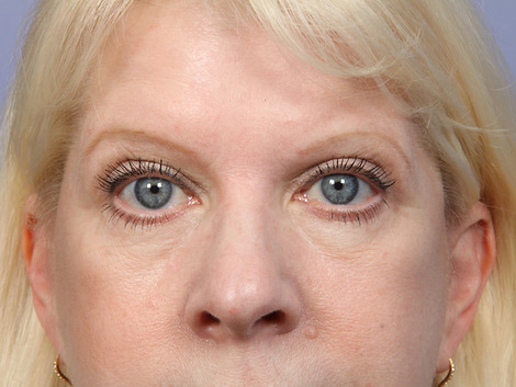 Eyelid Surgery before and after photo