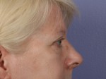 Eyelid Surgery Before and after photo