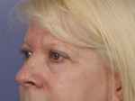 Eyelid Surgery Before and after photo