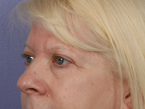 Eyelid Surgery before and after photo