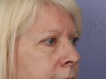 Eyelid Surgery Before and after photo