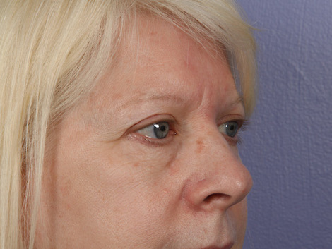 Eyelid Surgery before and after photo