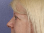 Eyelid Surgery Before and after photo