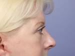 Eyelid Surgery Before and after photo