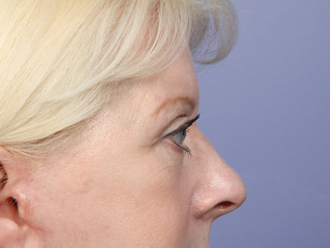 Eyelid Surgery before and after photo