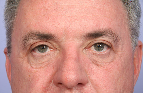 Eyelid Surgery before and after photo