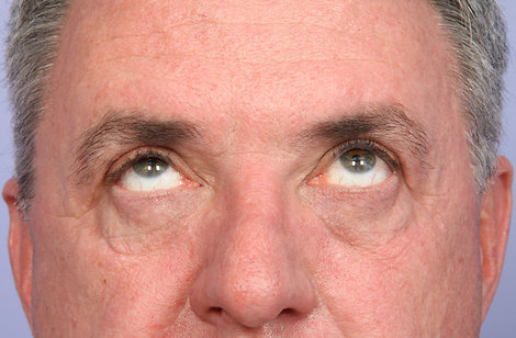 Eyelid Surgery before and after photo