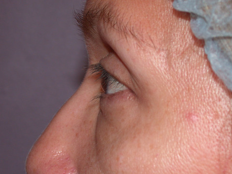 Eyelid Surgery before and after photo