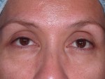 Eyelid Surgery