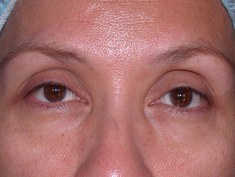 Eyelid Surgery before and after photo