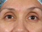 Eyelid Surgery