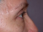 Eyelid Surgery Before and after photo