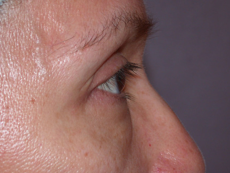 Eyelid Surgery before and after photo