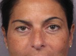 Eyelid Surgery
