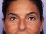 Eyelid Surgery