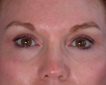 Eyelid Surgery Before and after photo