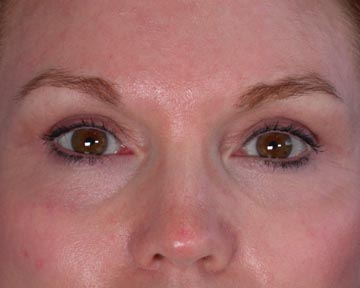 Eyelid Surgery before and after photo