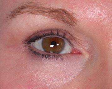 Eyelid Surgery before and after photo