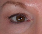 Eyelid Surgery Before and after photo