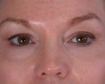 Eyelid Surgery