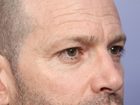 Eyelid Surgery before and after photo