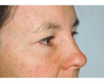 Eyelid Surgery